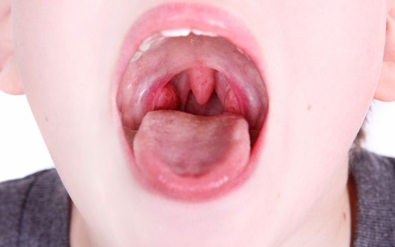 How to Get Rid of Tonsillitis at Home