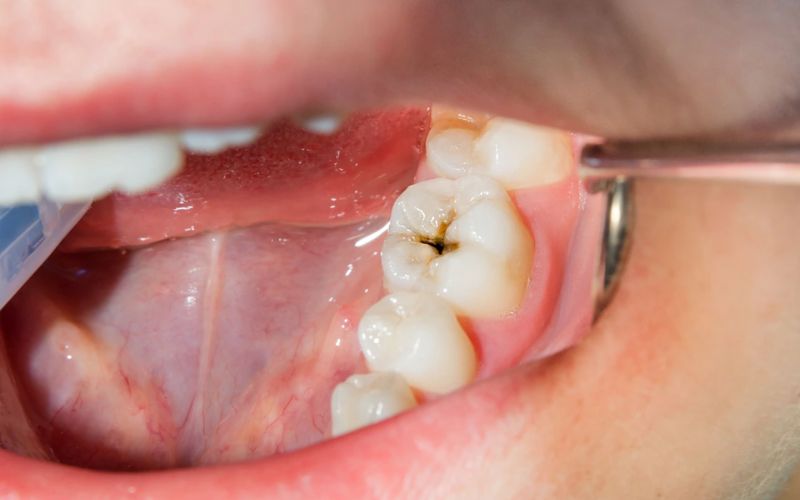 How Long Can You Leave a Cavity Untreated?