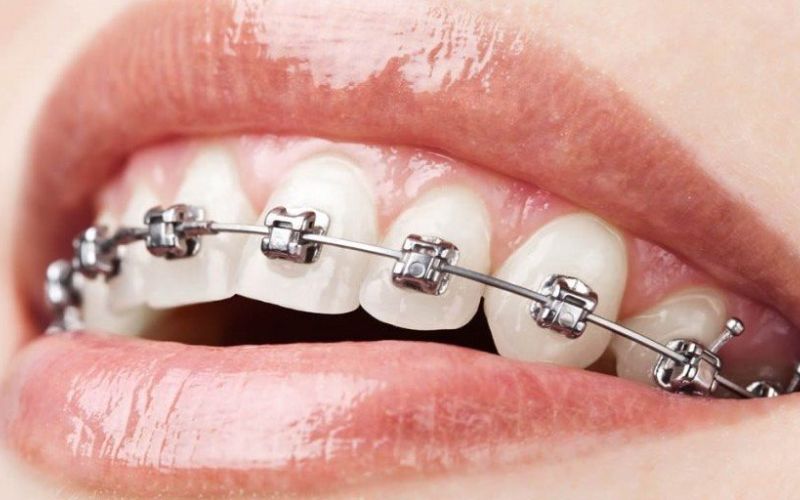 Can You Get Cavities Filled with Braces?