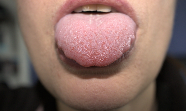 Swollen Tongue After Tonsillectomy