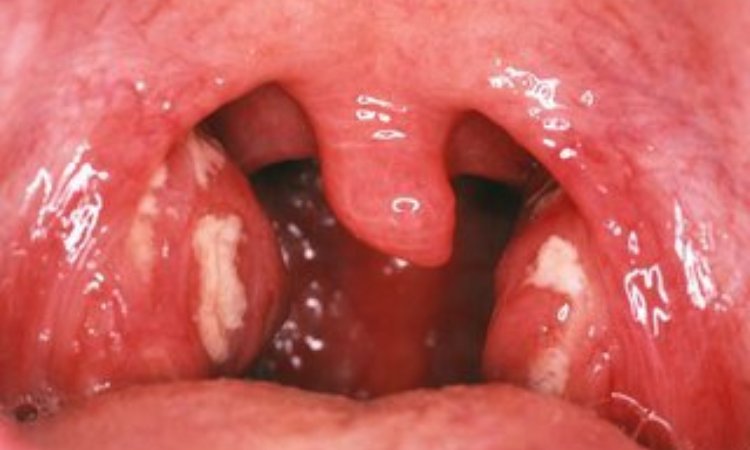 Can Oral Sex Cause Tonsil Stones and Tonsil Cancer?
